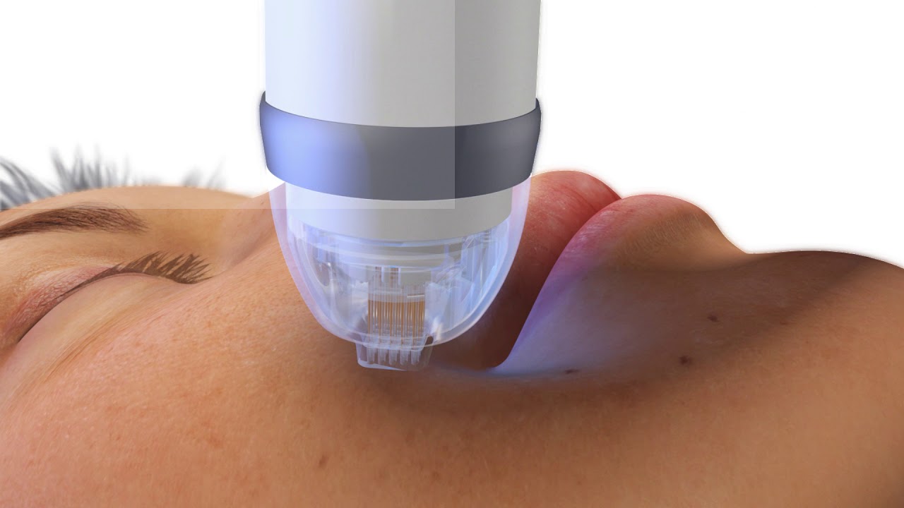 Мікроголковий RF Ліфтинг ENDYMED