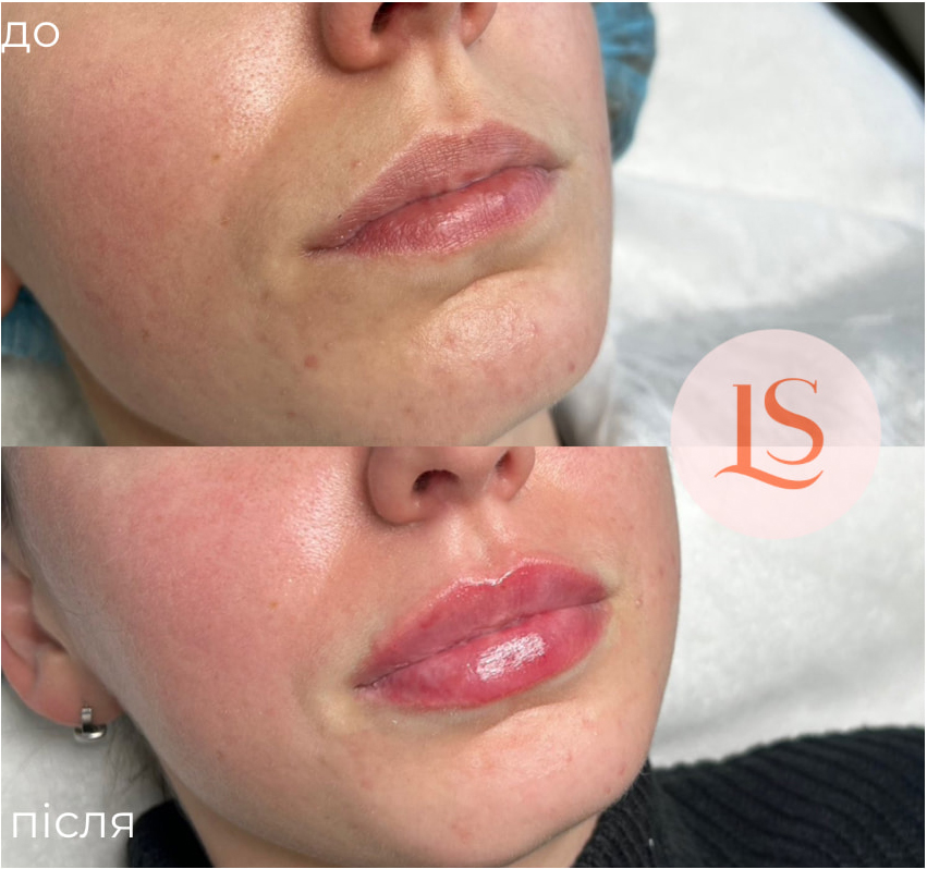 Збільшення губ-_10