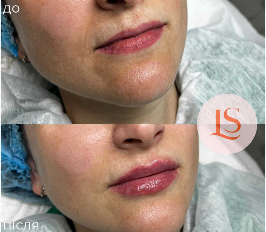 Збільшення губ-_10