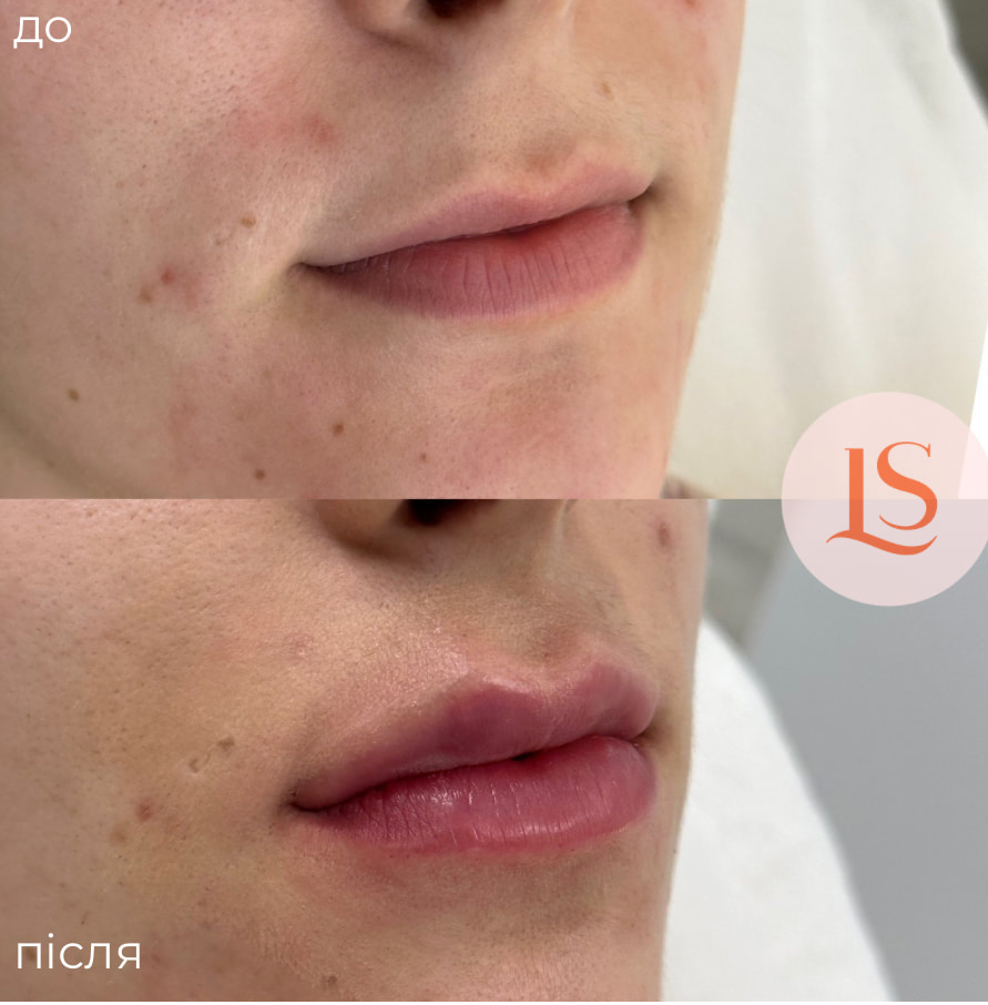 Збільшення губ-_10