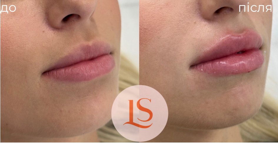 Збільшення губ-_10