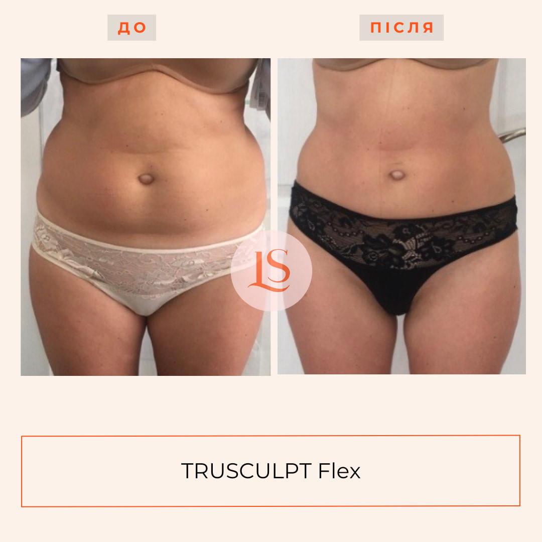 Корекція фігури на апараті TRUSCULPT Flex-_11