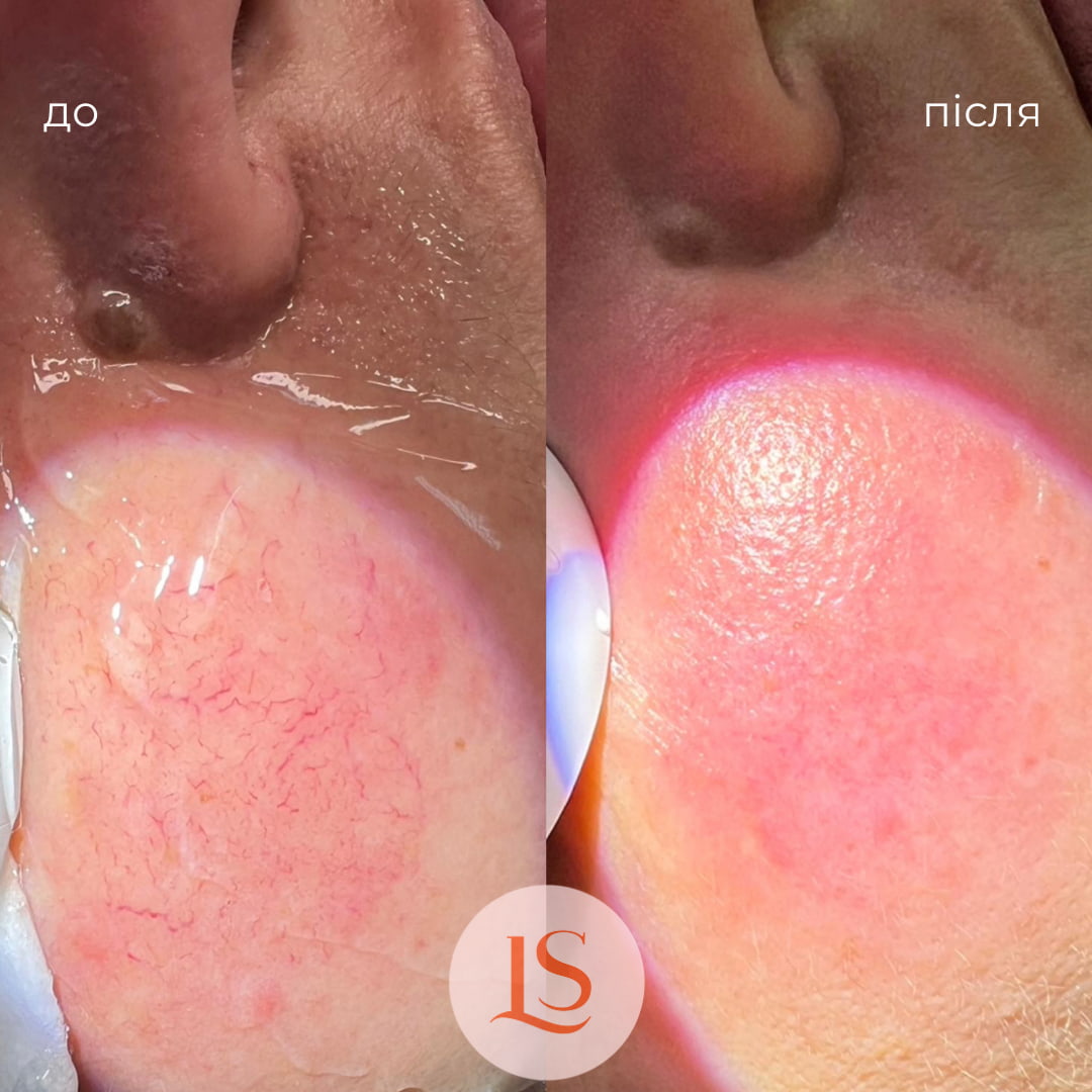 Лазерне видалення судин у Львові-_5