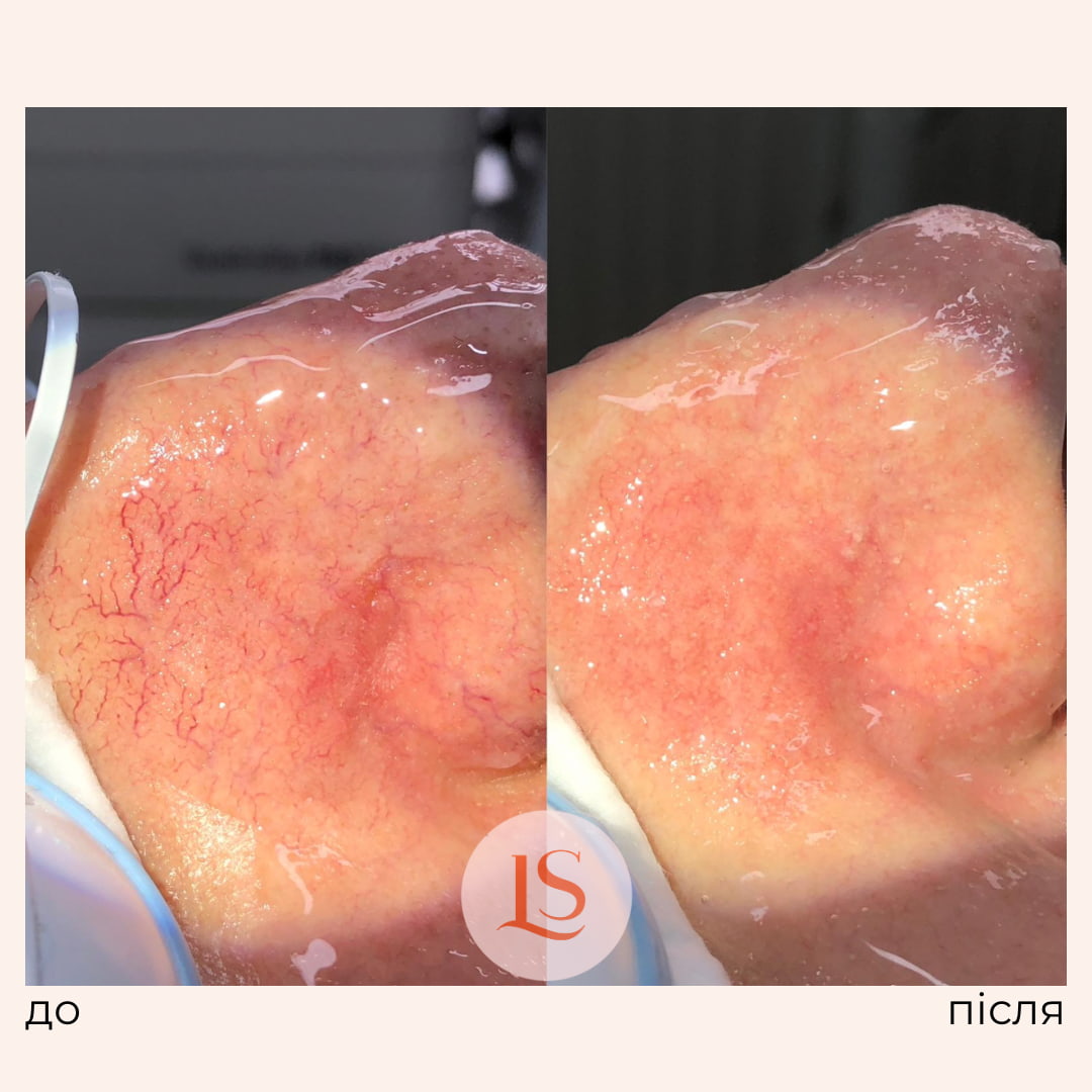 Лазерне видалення судин у Львові-_4