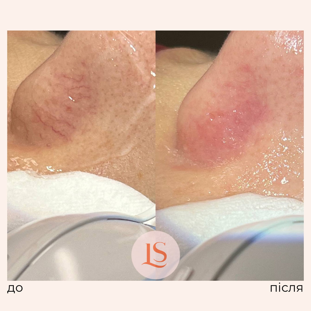 Лазерне видалення судин у Львові-_5