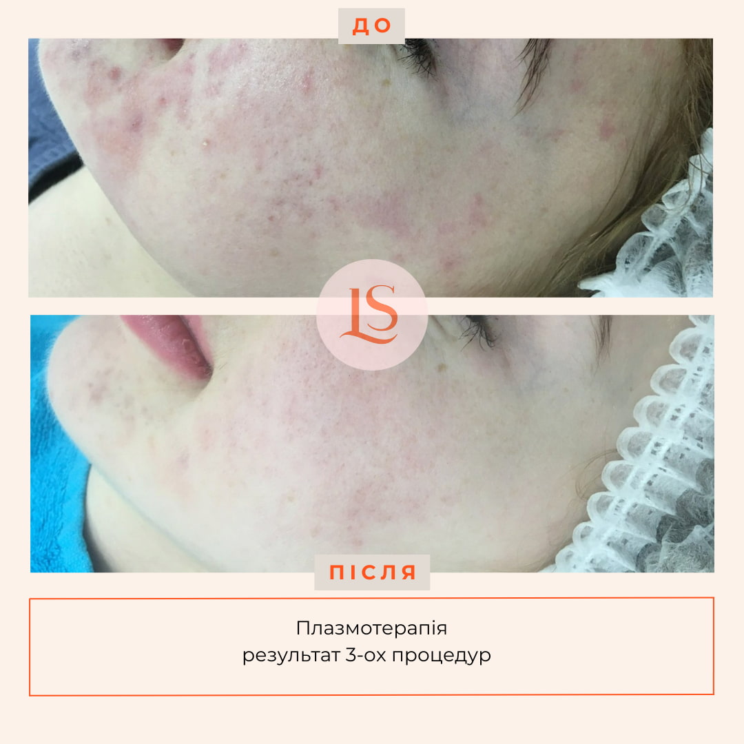 Плазмотерапія Endoret PRGF-_4