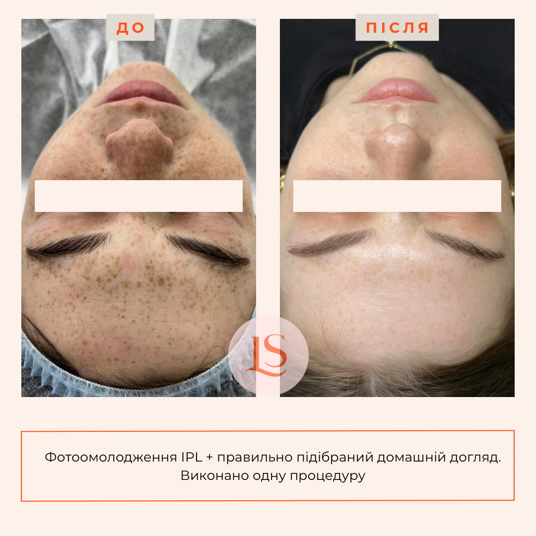 Фототерапія IPL-_9