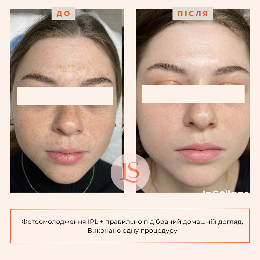 Фототерапія IPL-_8