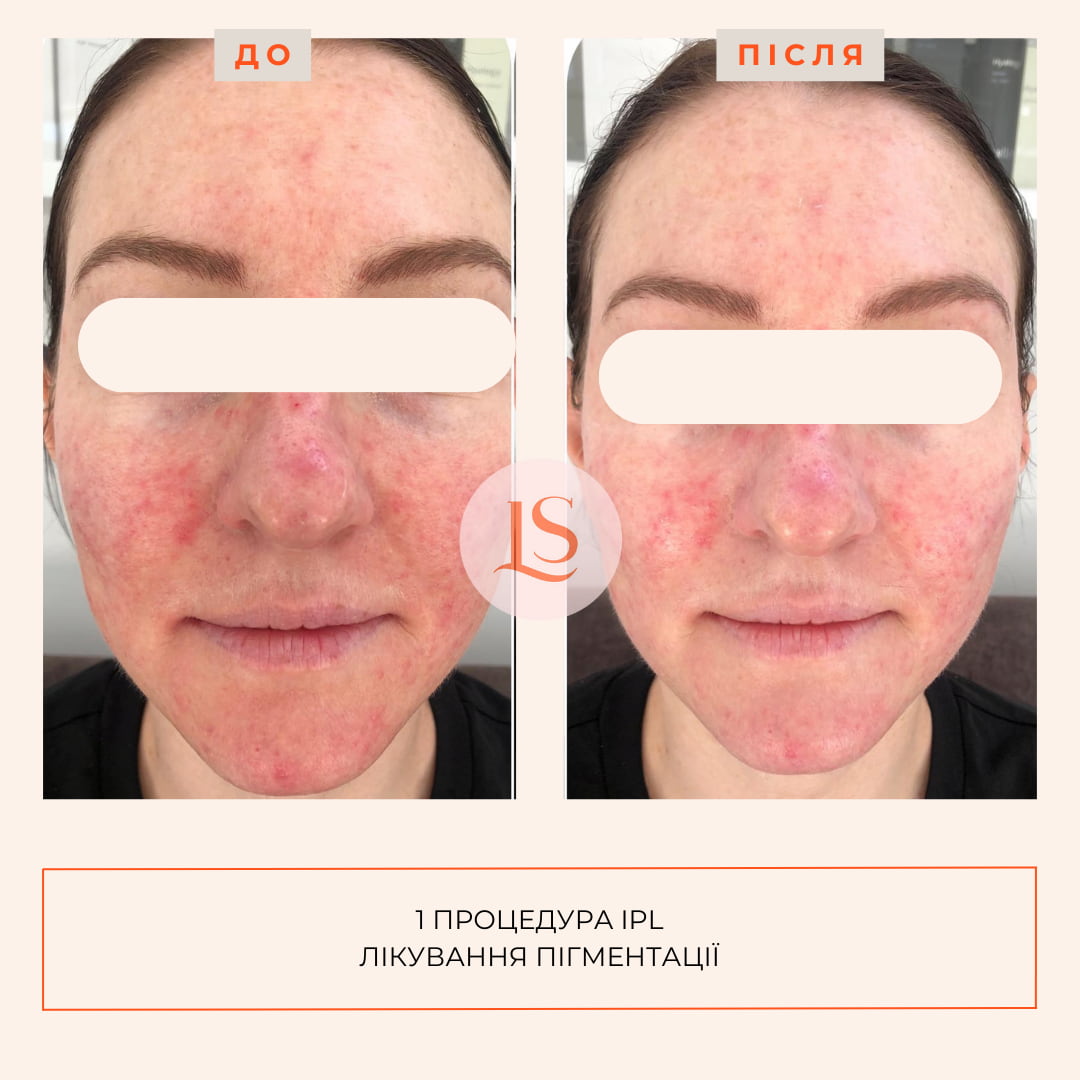 Фототерапія IPL-_9