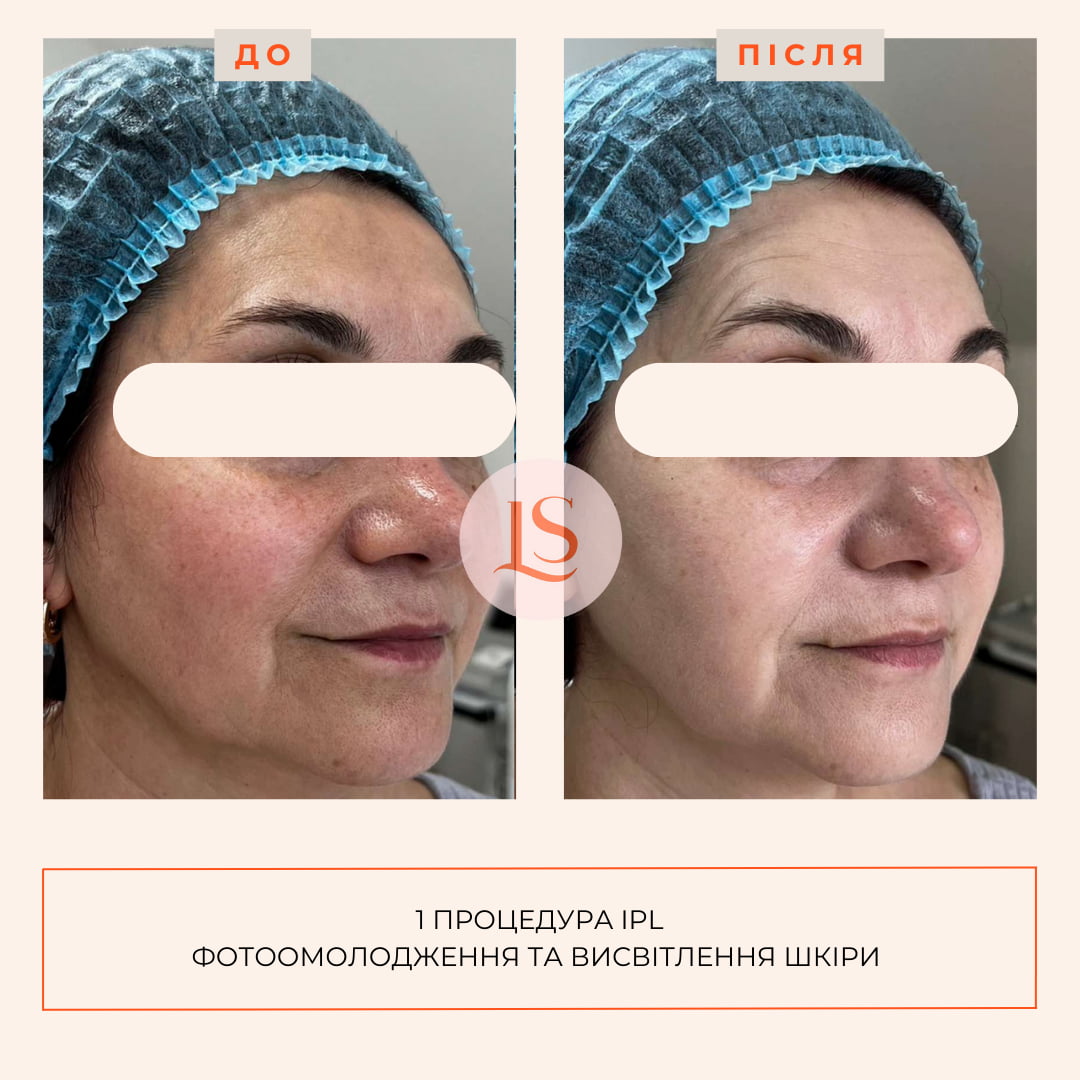 Фототерапія IPL-_6