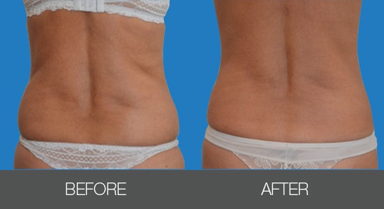 Кріоліполіз Cristal-_3