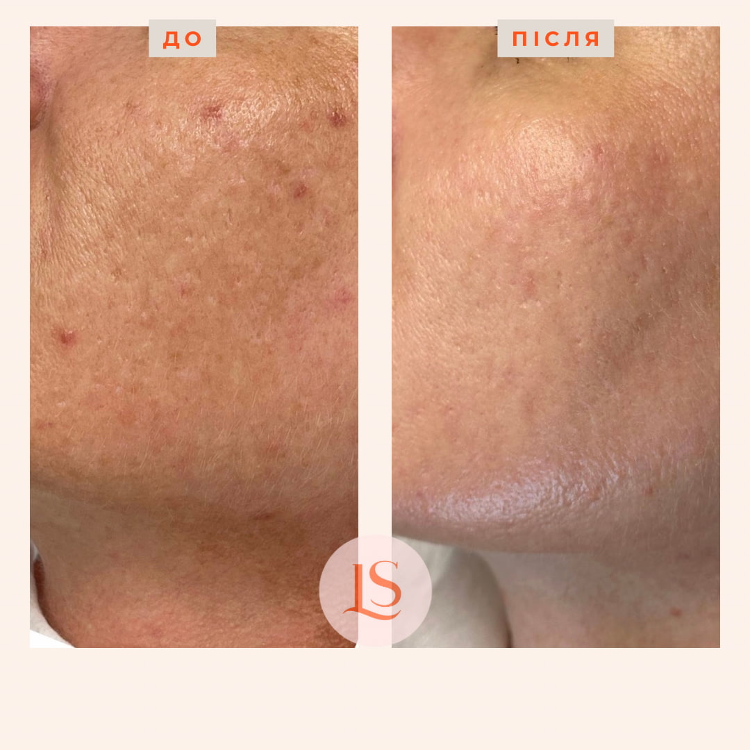 Шліфування шкіри Dermablate New-_3