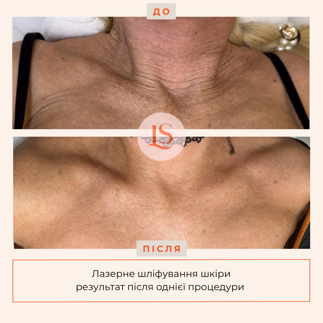Шліфування шкіри Dermablate New-_2