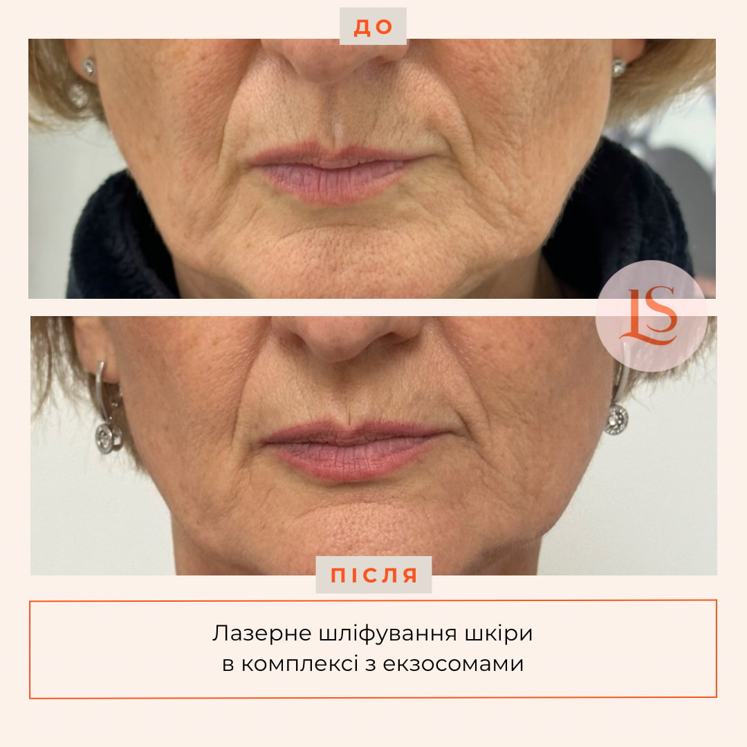 Шліфування шкіри Dermablate New-_1