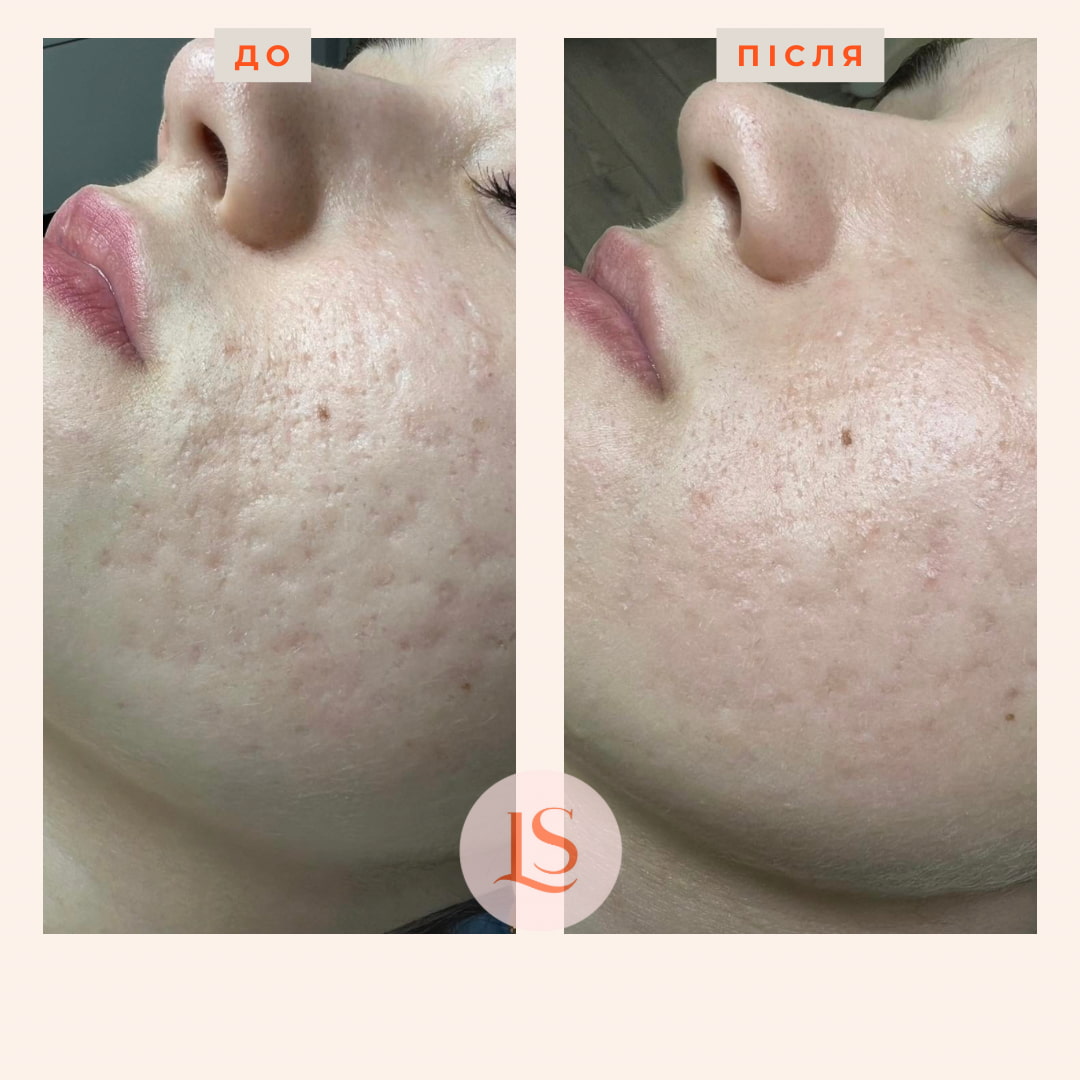 Шліфування шкіри Dermablate New-_5