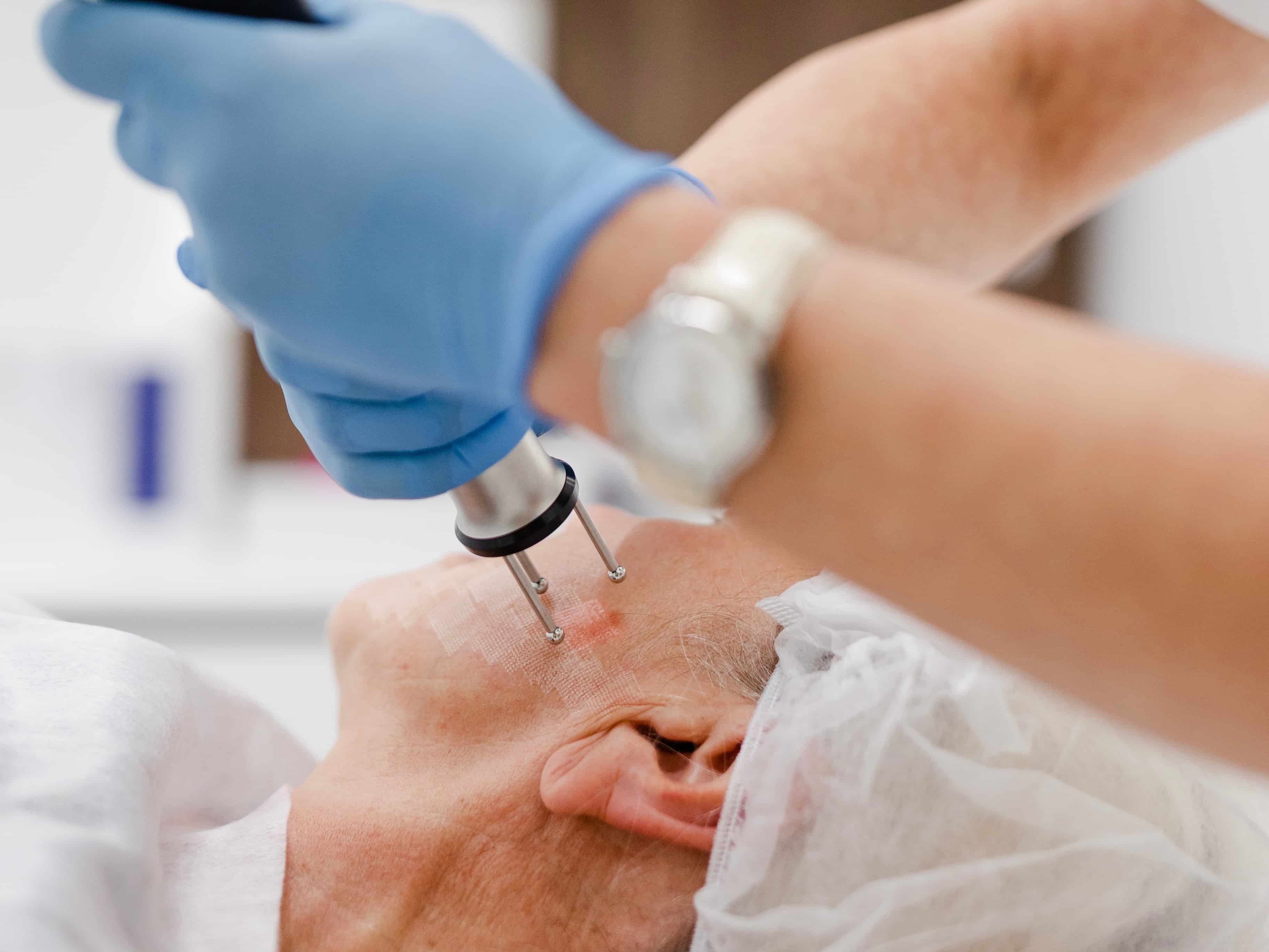 Шліфування шкіри Dermablate New-_6