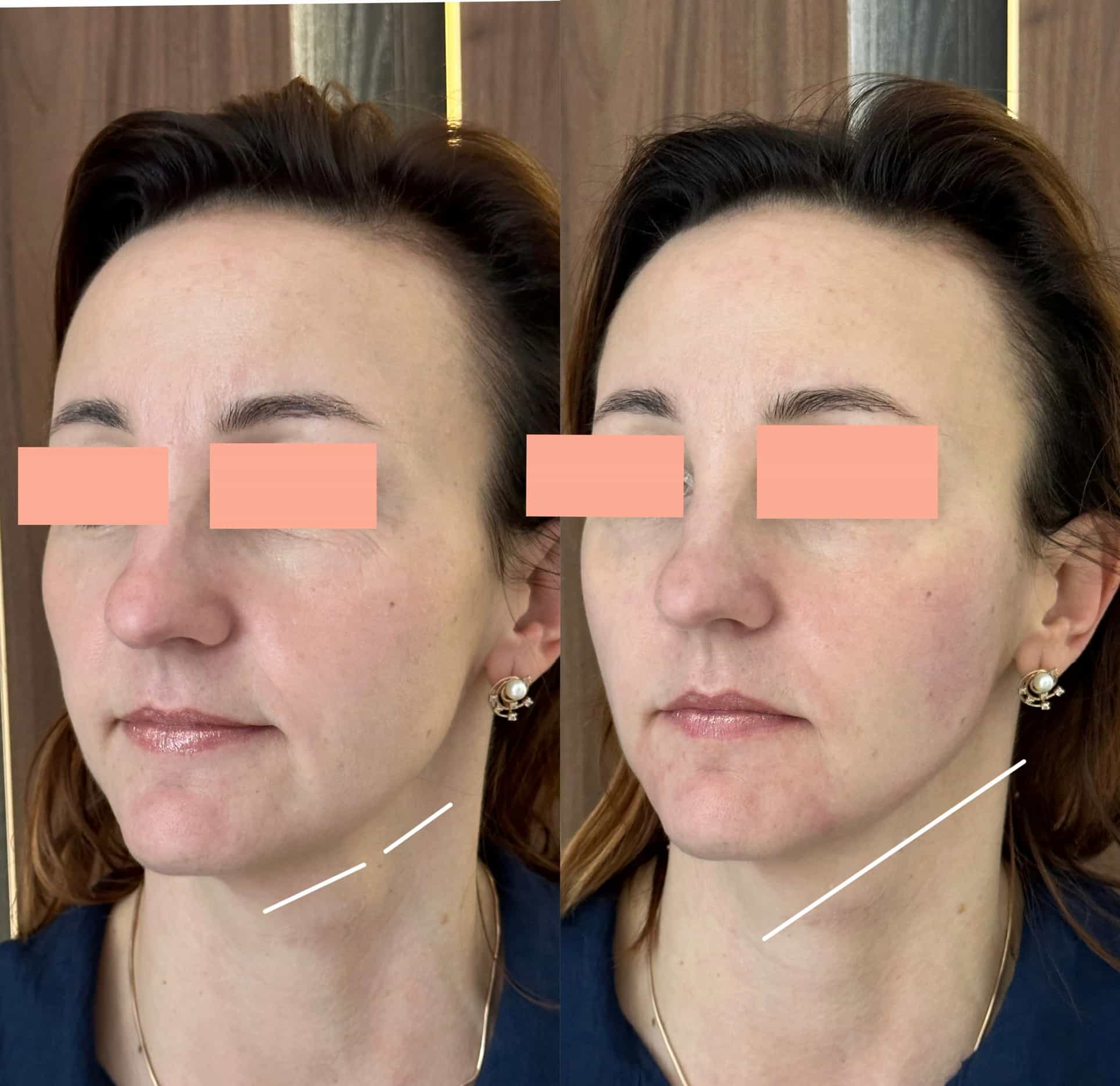 Ін'єкційна контурна пластика-_11