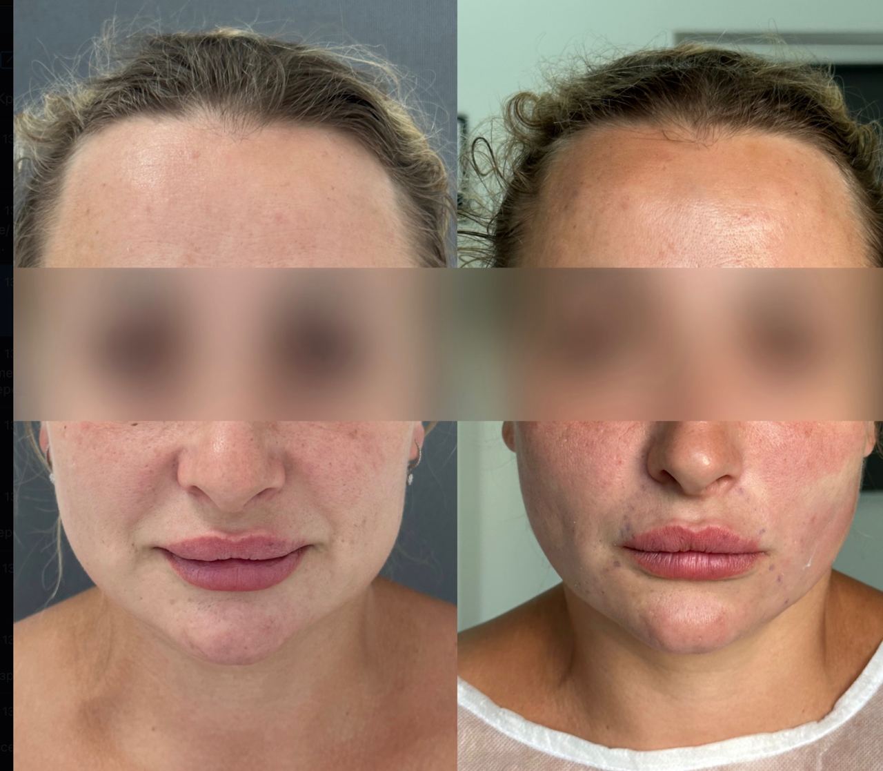 Підтяжка обличчя нитками APTOS-_5 Підтяжка обличчя нитками APTOS-_5