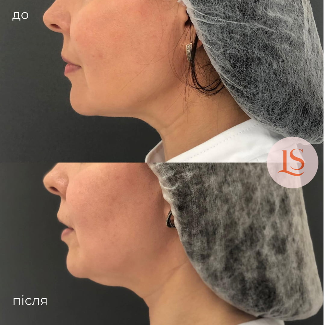 SMAS-ліфтинг-_7