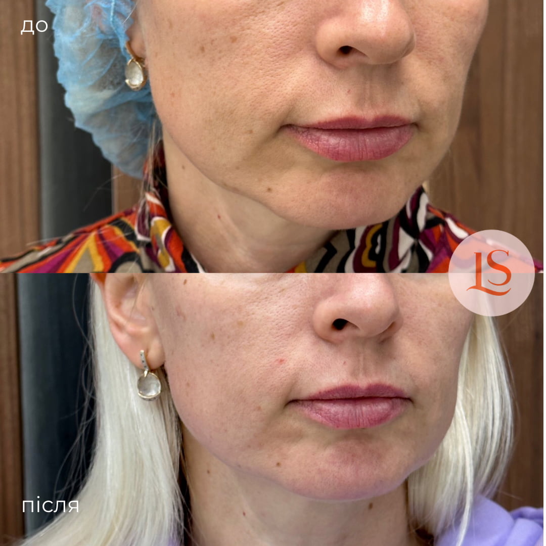 SMAS-ліфтинг-_6