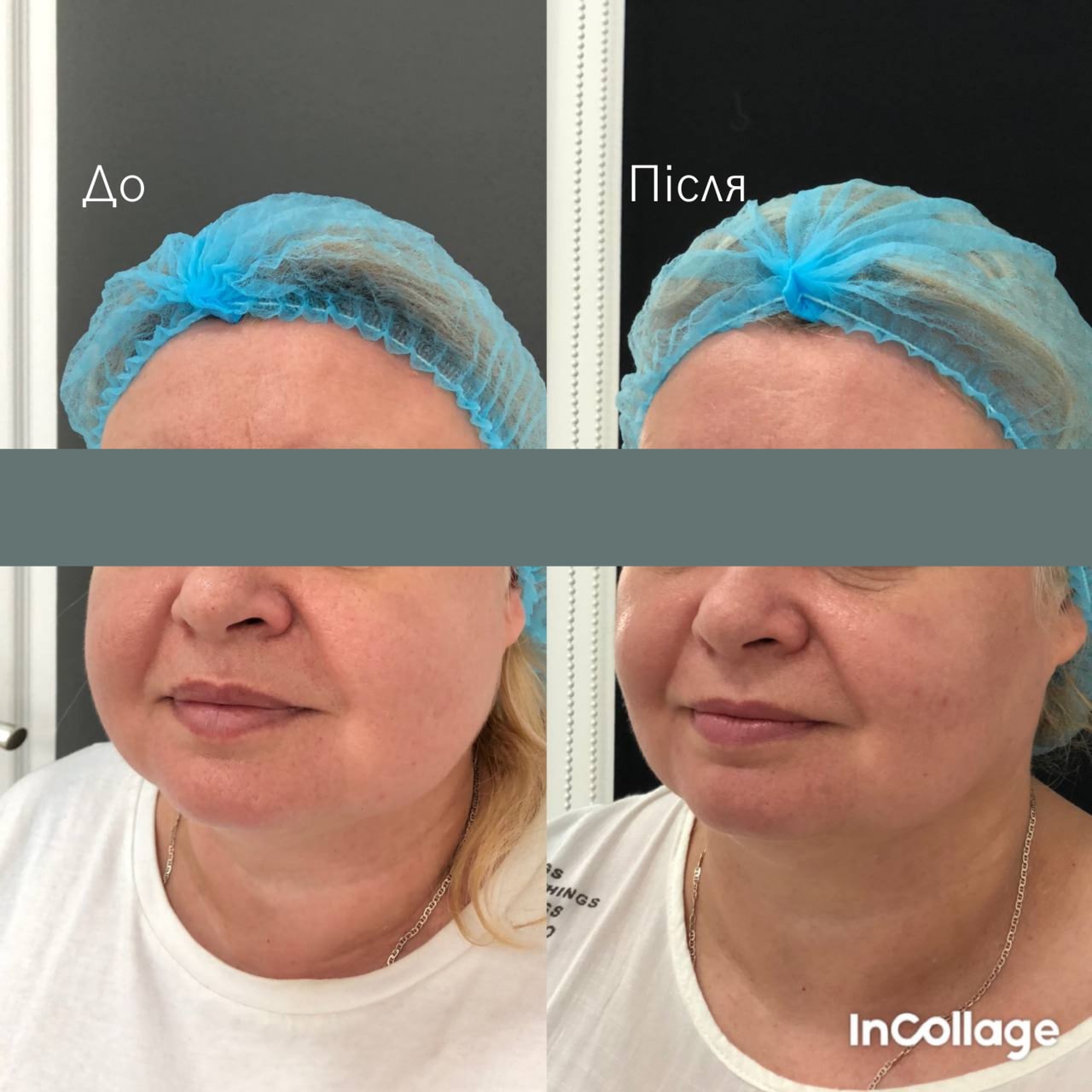 Ліфтинг обличчя Agnes-_2 Ліфтинг обличчя Agnes-_2