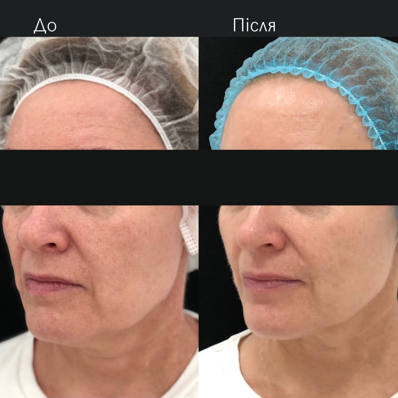 Ліфтинг обличчя Agnes-_3 Ліфтинг обличчя Agnes-_3