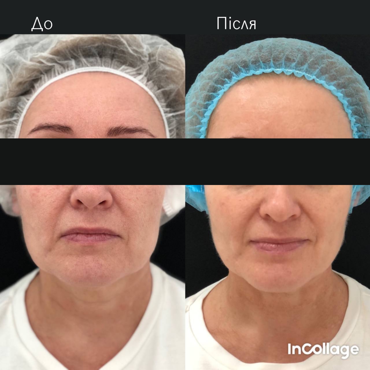 Ліфтинг обличчя Agnes-_4 Ліфтинг обличчя Agnes-_4