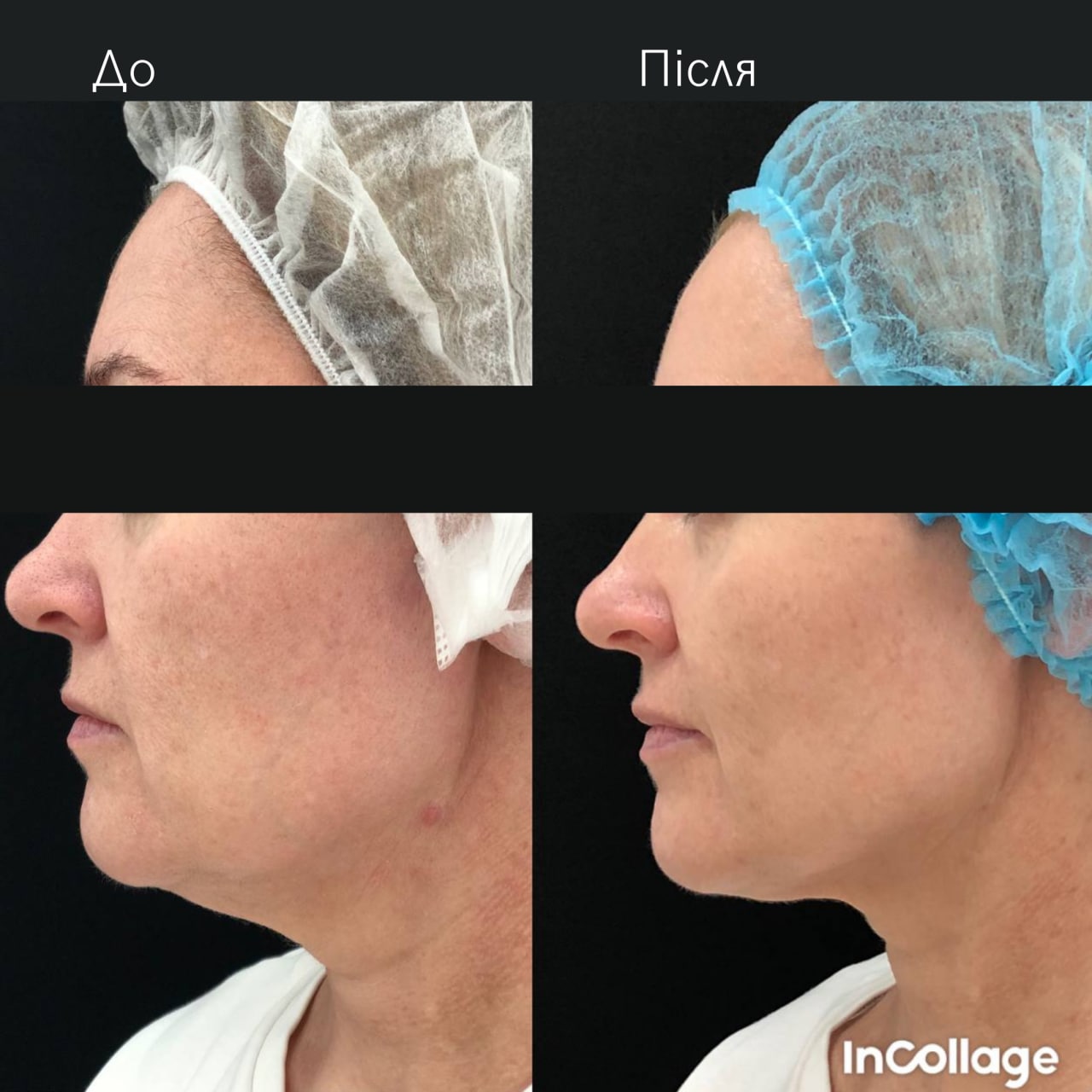 Ліфтинг обличчя Agnes-_5 Ліфтинг обличчя Agnes-_5