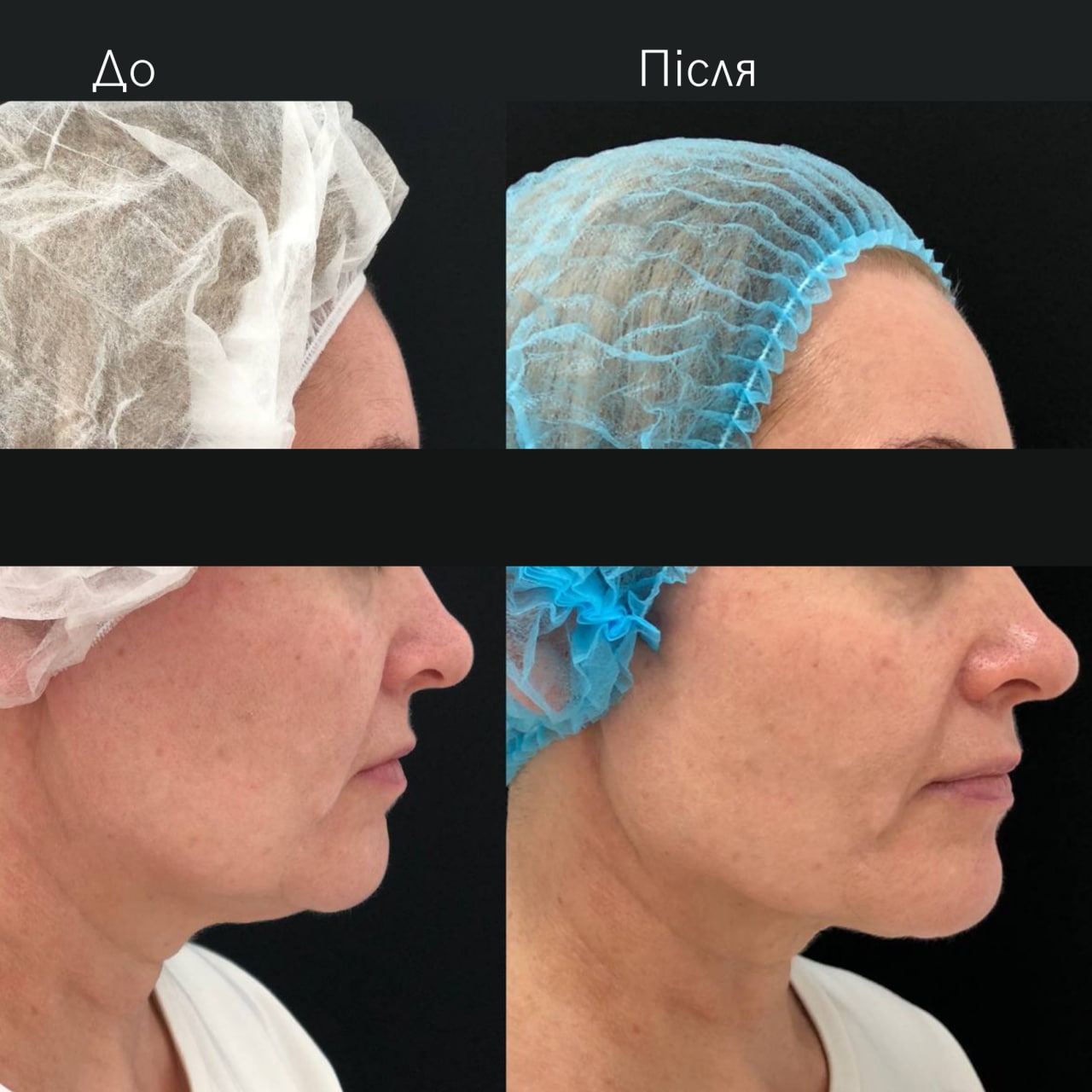 Ліфтинг обличчя Agnes-_6 Ліфтинг обличчя Agnes-_6