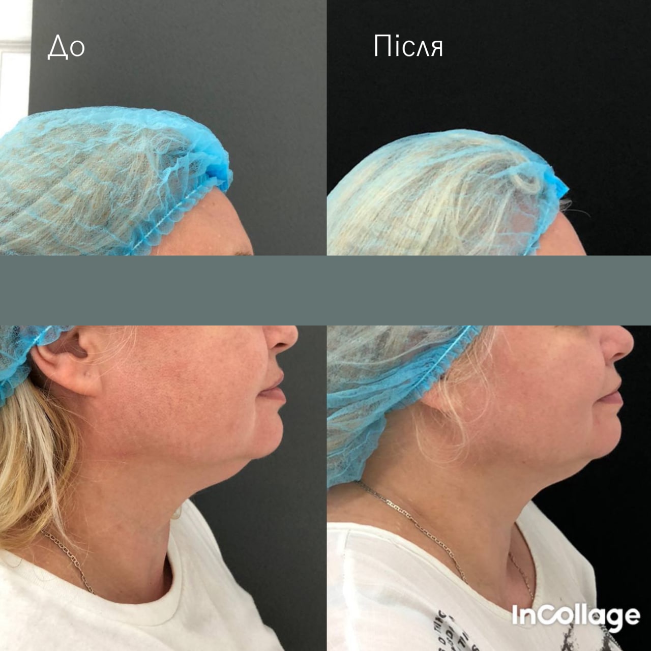 Ліфтинг обличчя Agnes-_7 Ліфтинг обличчя Agnes-_7