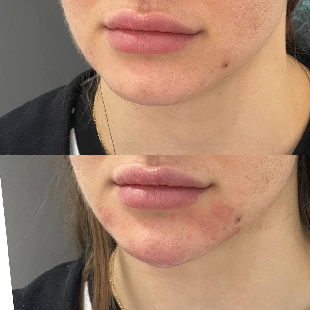 Ін'єкційна контурна пластика-_4