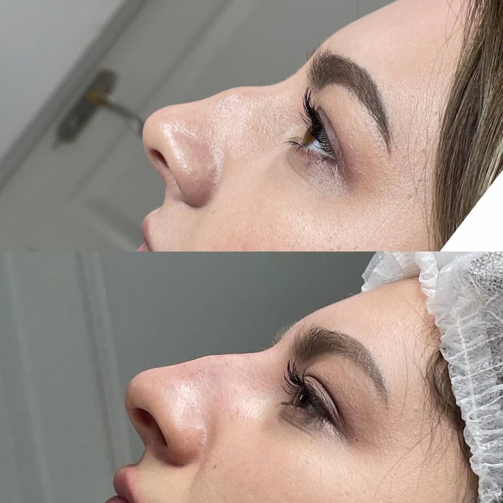 Ін'єкційна контурна пластика-_7